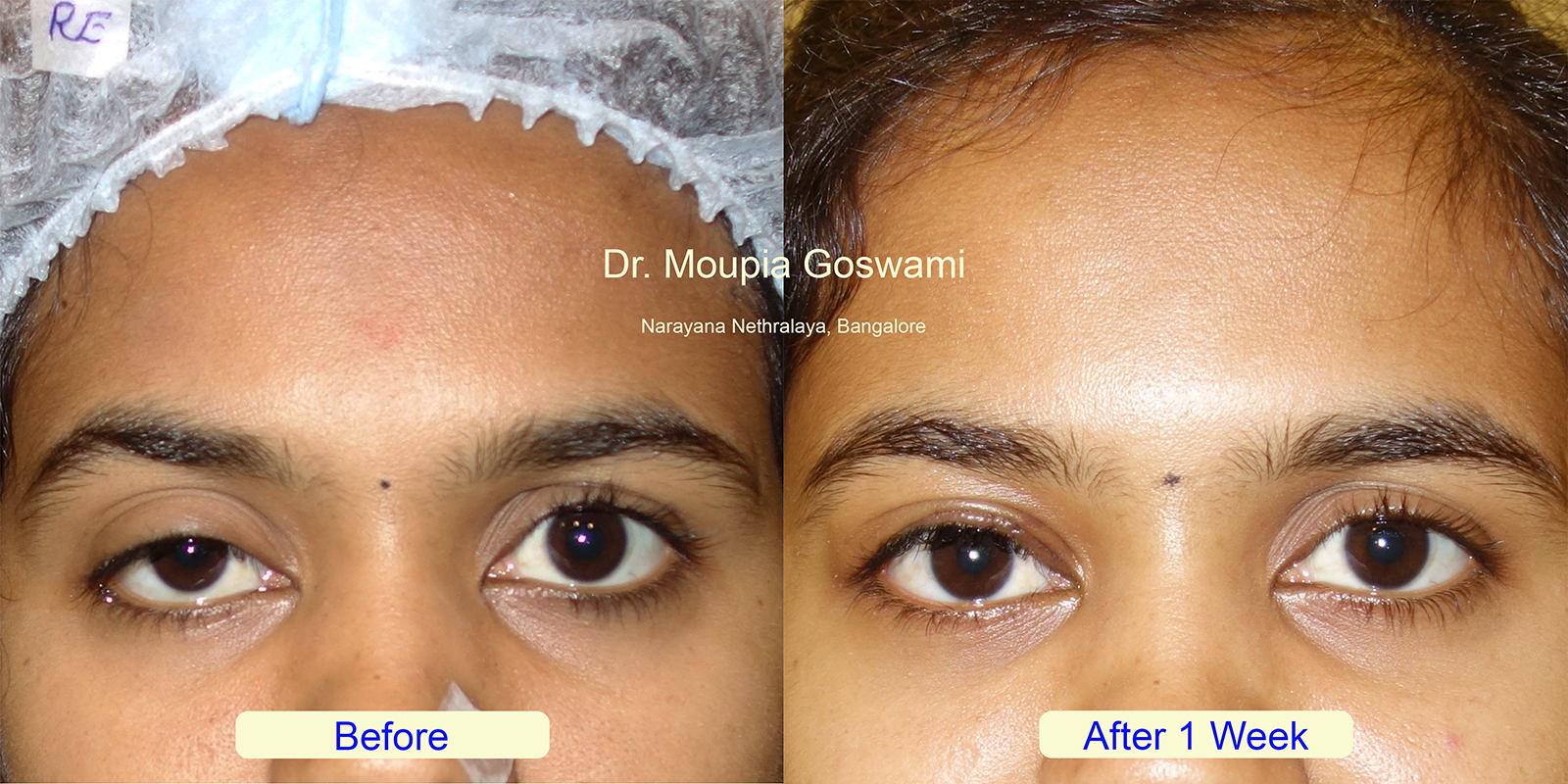 Before and After Ptosis Surgery Result Photo 1