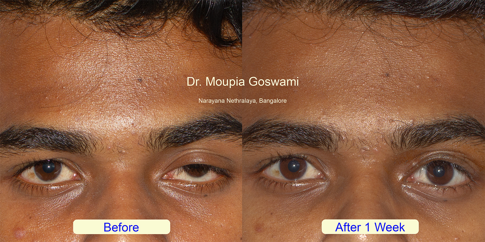 Before and After Ptosis Surgery Result Photo 10