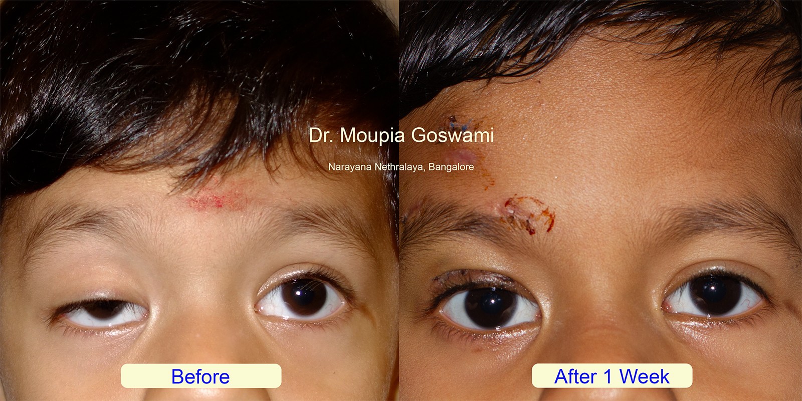 Before and After Ptosis Surgery Result Photo 12