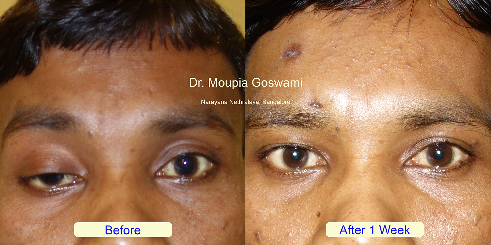 Before and After Ptosis Surgery Result Photo 6