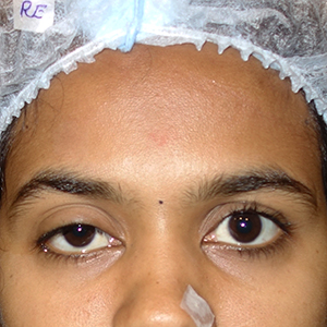 Ptosis case 1