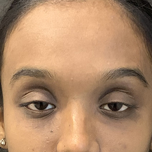 Ptosis case 6