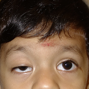 Ptosis case 2