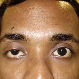 Ptosis case 3