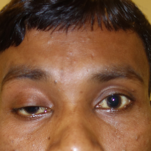 Ptosis case 4