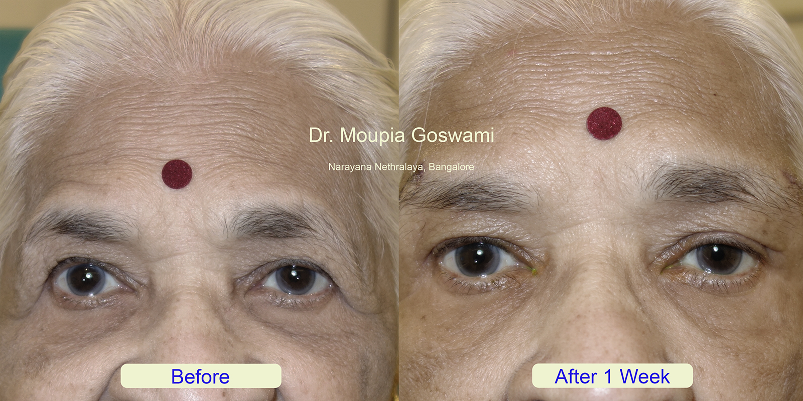 Before and After Eyelid Enhancement