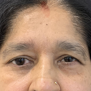 Photo 2 of a lady with Asian Eyelid or Monolid