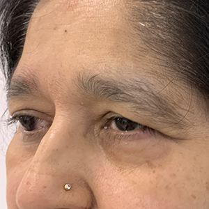 Photo 3 of a lady with Asian Eyelid or Monolid