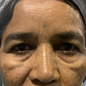 Photo 4 of a lady with Asian Eyelid or Monolid