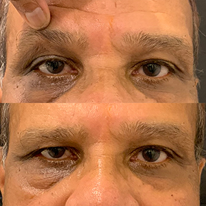 Photo 6 of a lady with Asian Eyelid or Monolid